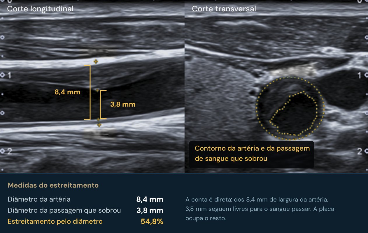 O mesmo vaso em dois cortes. Os colchetes mostram onde o diâmetro foi medido: de parede a parede e no que sobrou de passagem.