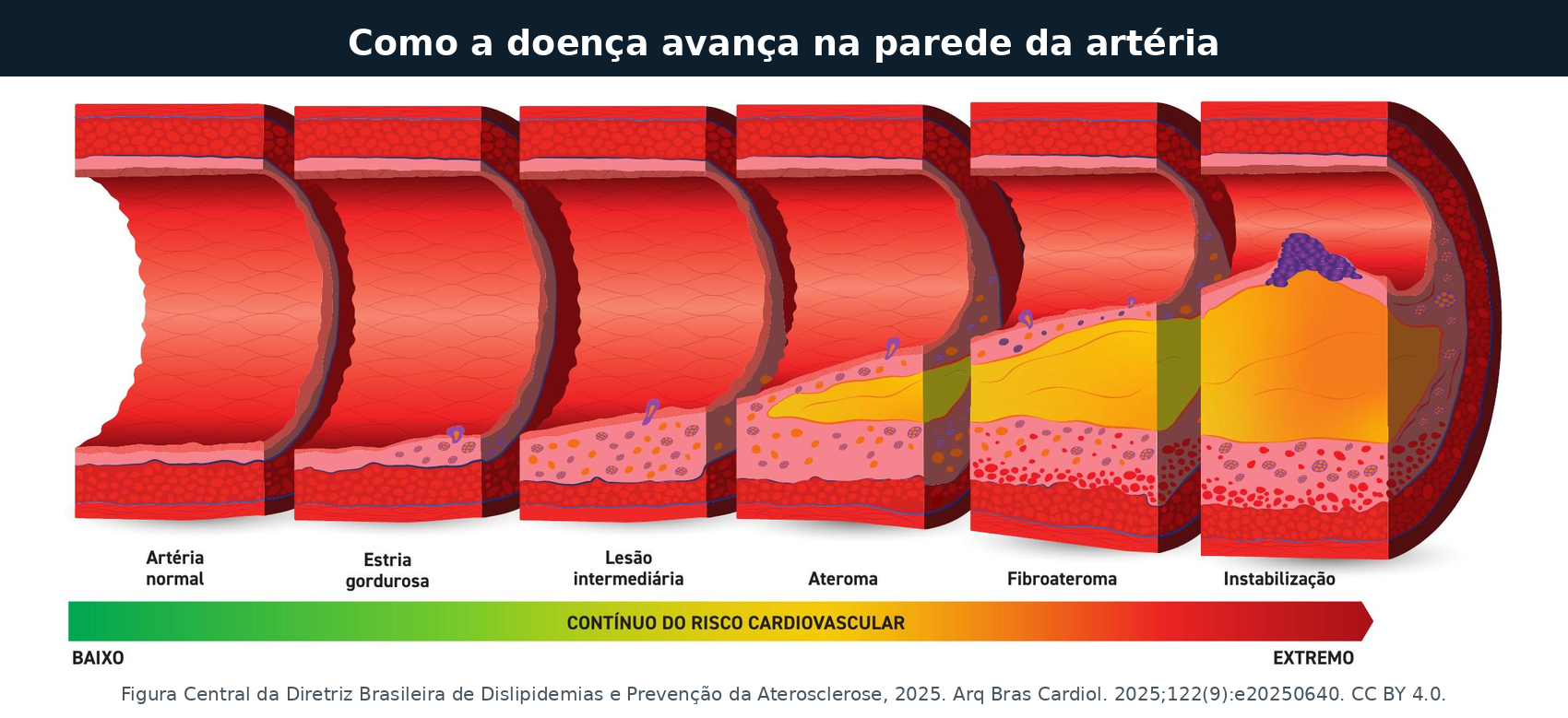 Sequência de seis artérias mostrando a progressão da aterosclerose, da artéria normal até a instabilização da placa